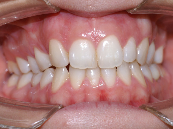 Cas clinique d'orthodontie linguale, préparation orthodontique pour implants et facettes