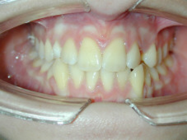 Cas Clinique d'orthodontie linguale, traitement à bordeaux