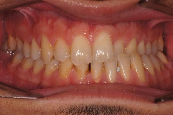 Latero mandibule traitée par orthodontie chirurgicale en technique linguale