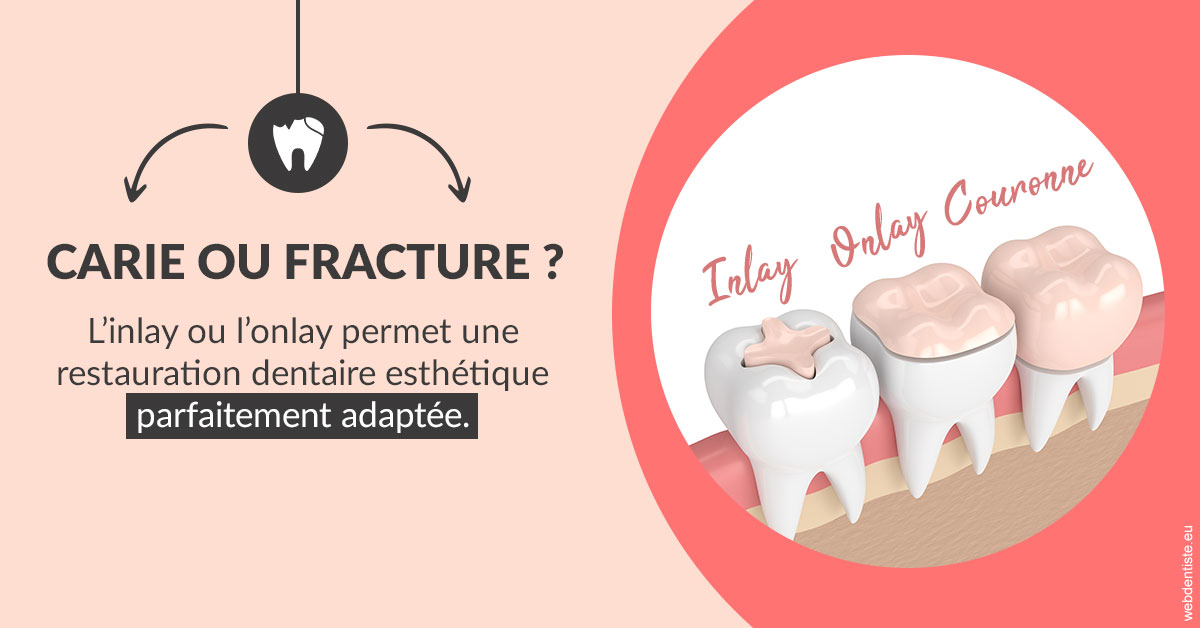 https://dr-le-petit-xavier.chirurgiens-dentistes.fr/T2 2023 - Carie ou fracture 2