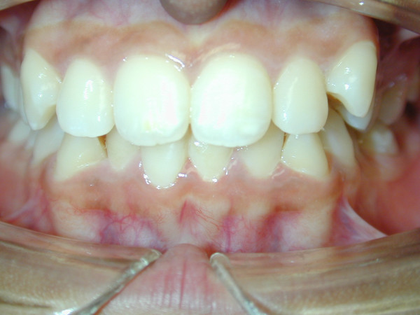 Orthodontie Linguale Bordeaux