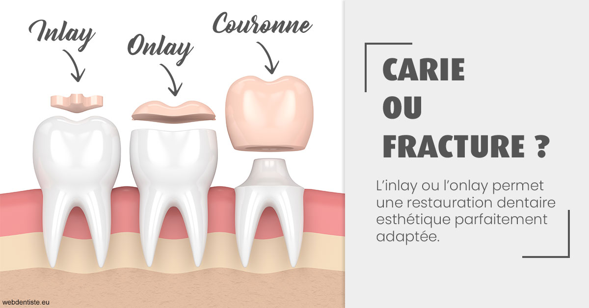 https://dr-le-petit-xavier.chirurgiens-dentistes.fr/T2 2023 - Carie ou fracture 1