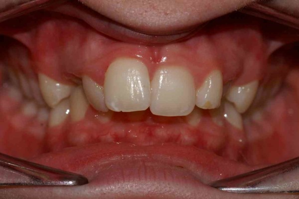 Important décalage des dents - cas traité au cabinet d'Orthodontie à Bordeaux