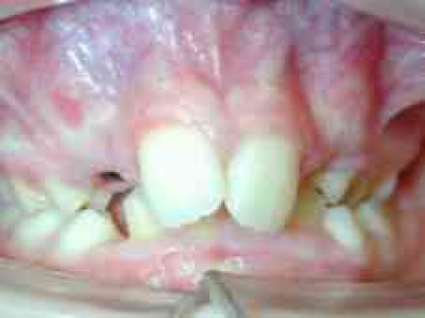Fentes palatines bilatérales, cas traité au cabinet d'orthodontie du Dr Le petit à Bordeaux