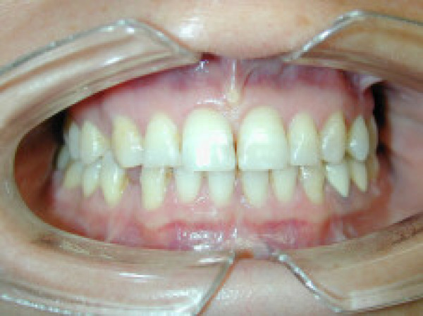 Cas d'orthodontie linguale, dents écartées