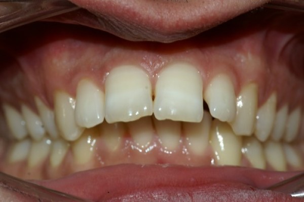 Morphing d'un Cas d'orthodontie linguale