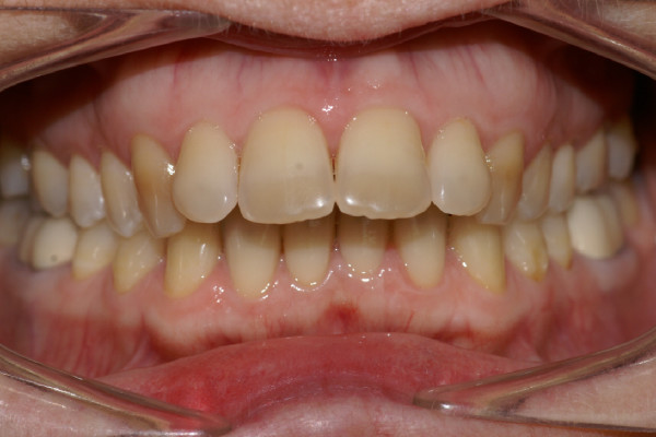 Cas Clinique d'orthodontie linguale, typologie classe II division 1
