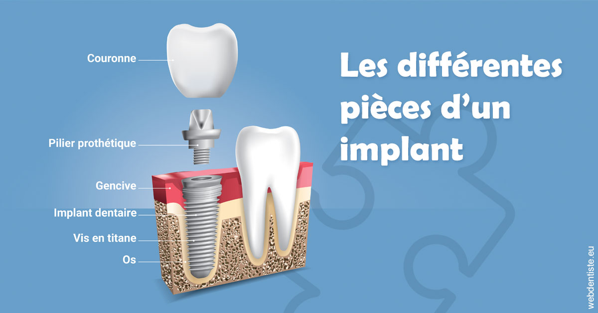 https://dr-le-petit-xavier.chirurgiens-dentistes.fr/Les différentes pièces d’un implant 1
