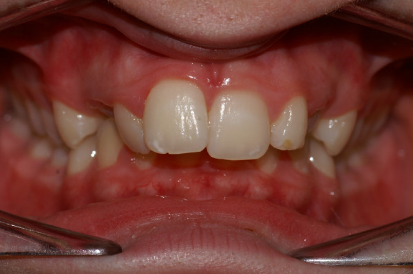 Décalage des mâchoires traité sans extraire de dents