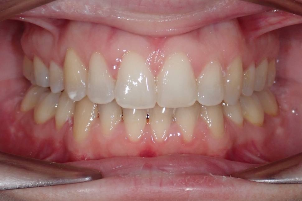 19-02-2020 Intra-orale Face S-Fin de traitement