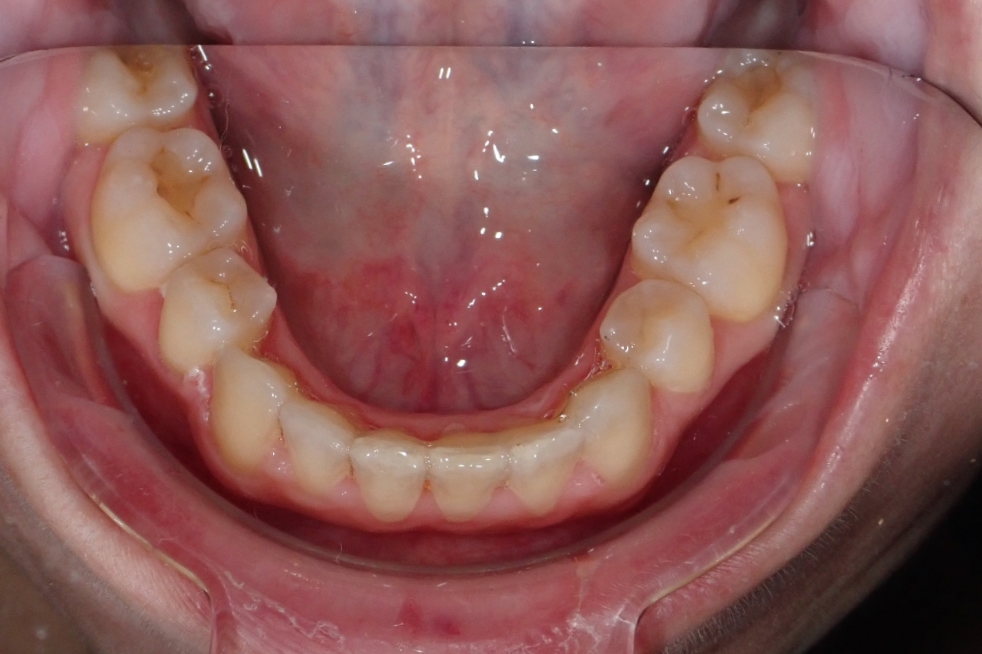 19-02-2020 Intra-orale Inférieure S-Fin de traitement