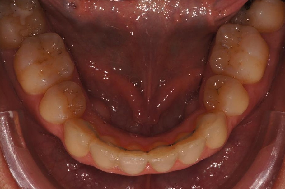 26-11-2014 Intra-orale Inférieure C-Début 3