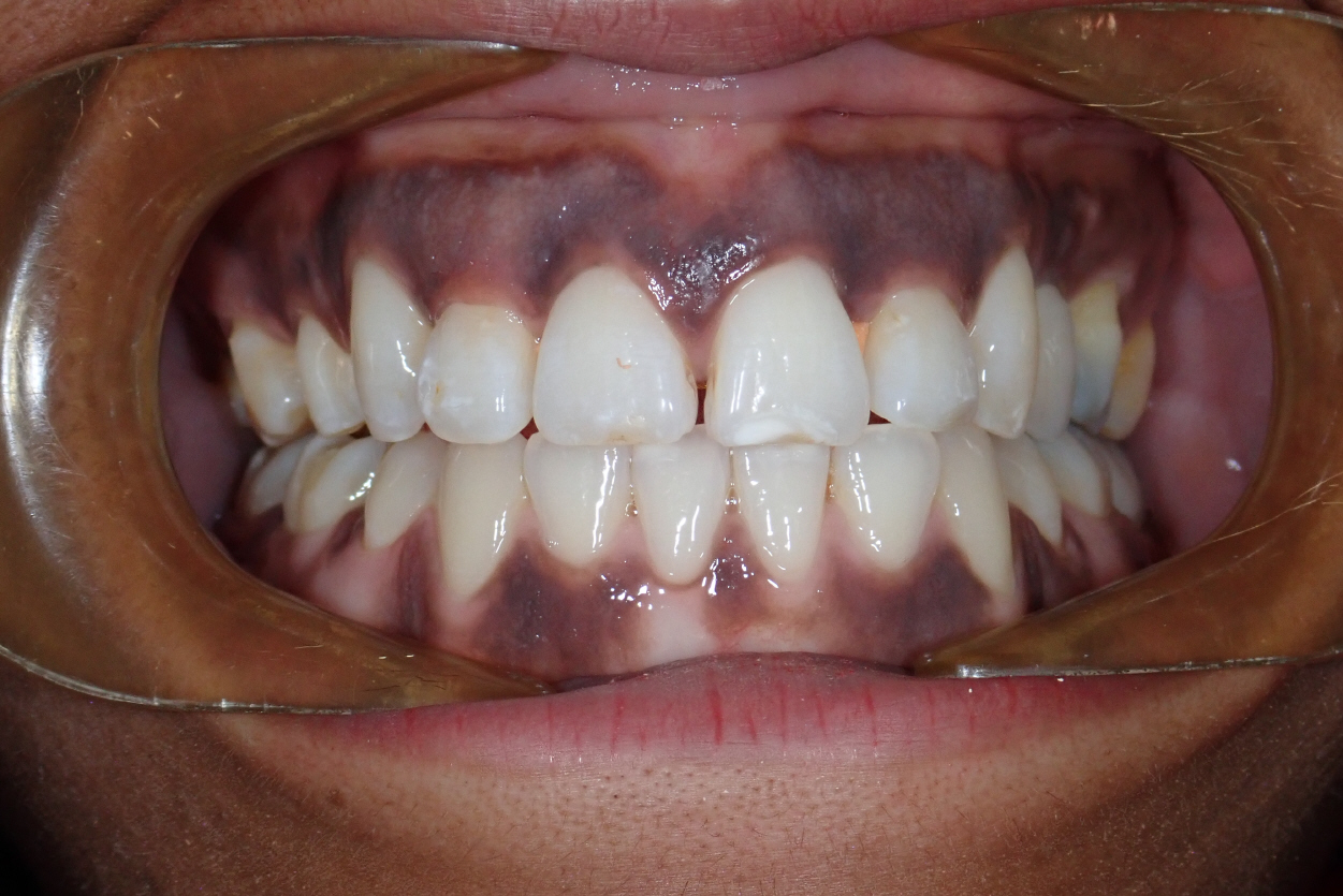 24-01-2020 Intra-orale Face S-Fin de traitement